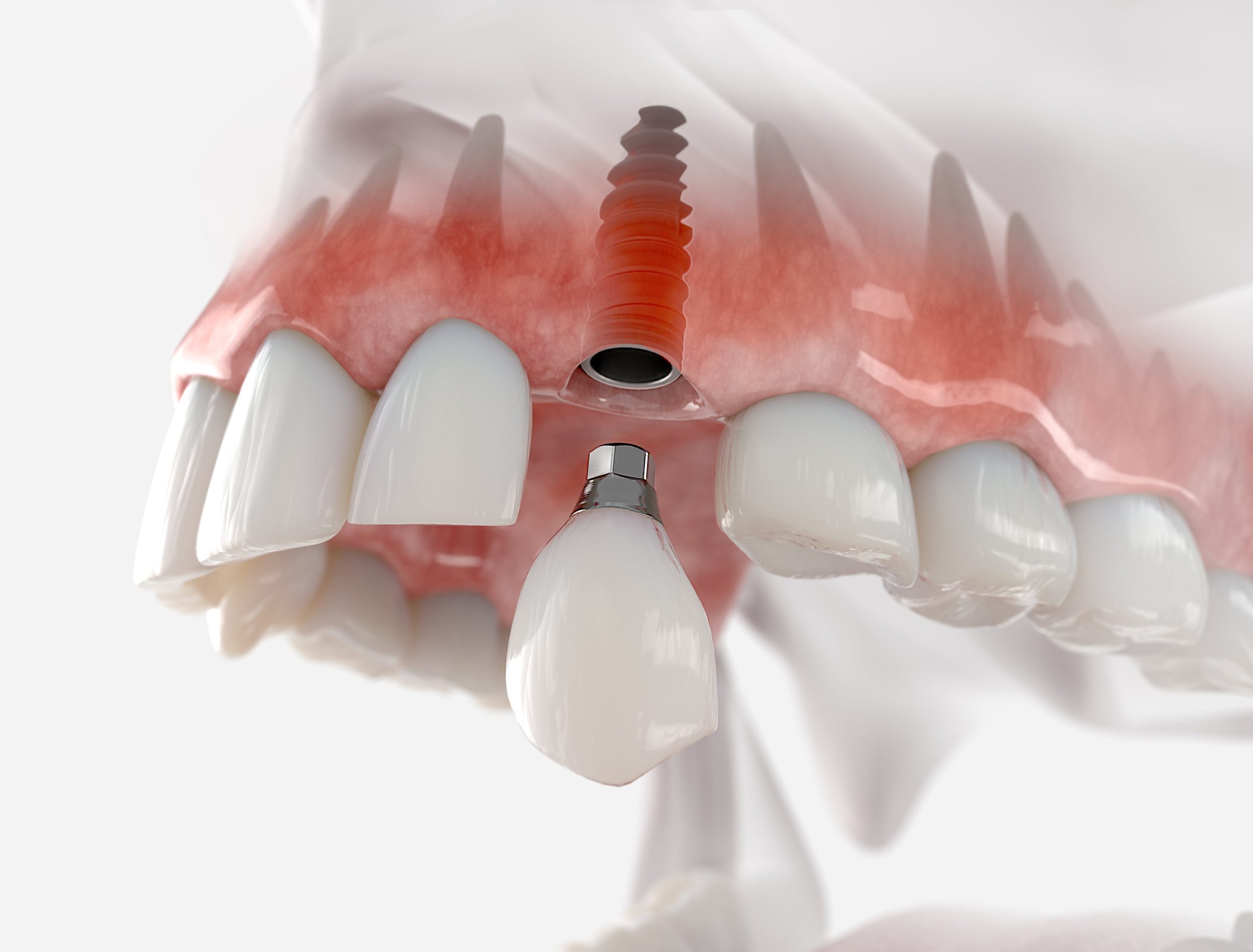 Dental Implants - East Coast Surgical Centre